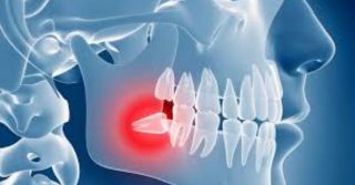 What to Eat After Wisdom Teeth Removal