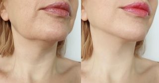 Jowls: Causes, Prevention, and Your Comprehensive Treatment Guide