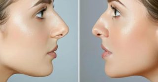 Tip Rhinoplasty vs. Full Rhinoplasty vs. Liquid Rhinoplasty